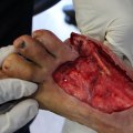 The Power of Wet Wound Healing: How to Speed Up the Healing Process