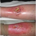 The Healing Power of Natural Remedies for Skin Wounds