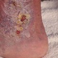 Why A Quick Cellulitis Diagnosis Of The Lower Limb Is Crucial In Emergency Wound Care