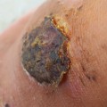 The Truth About Wound Healing: Covered or Uncovered?