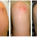 Step-by-Step Guide to Hypertrophic Scar Healing Stages in Emergency Wound Management