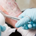 How to Treat an Excoriation Wound: Effective Healing Methods to Prevent Further Skin Damage