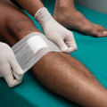 The Best Time to Remove Wound Dressing