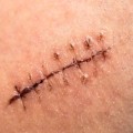 How Long Do Dissolvable Stitches Last? What You Need to Know for the Best Care