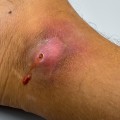 The Best and Worst Ways to Treat Open Wounds