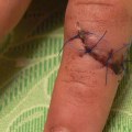 Navigating What Do Dissolvable Stitches Healing Stages Look Like During Emergency Wound Care