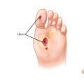 How to Distinguish Venous Ulcer Vs Arterial Ulcer Vs Diabetic Ulcer During Emergency Wound Care