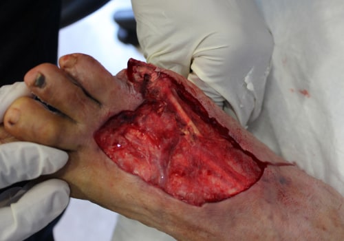 The Power of Wet Wound Healing: How to Speed Up the Healing Process