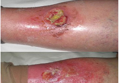 The Healing Power of Natural Remedies for Skin Wounds