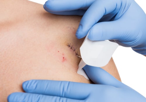 Understanding Healing: What Do Dissolvable Stitches Look Like in Emergency Wound Care Cases?