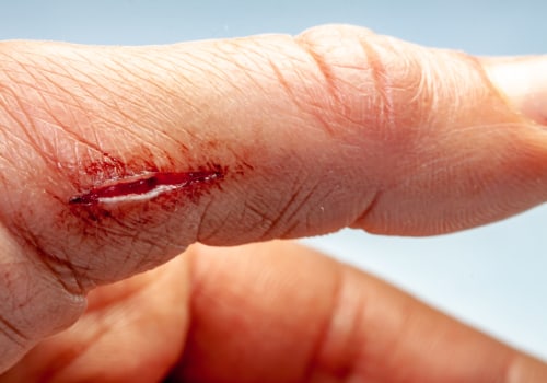 A Guide To Healing Stages For Surgical Wounds, Scars, And Stitches After Emergency Procedures