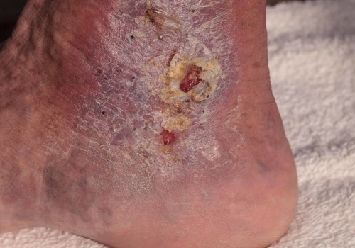 Why A Quick Cellulitis Diagnosis Of The Lower Limb Is Crucial In Emergency Wound Care