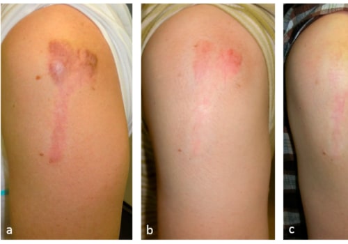 Step-by-Step Guide to Hypertrophic Scar Healing Stages in Emergency Wound Management