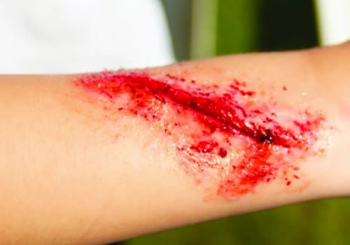 Wound Infection Symptoms and Emergency Care Tips for Fast Recovery