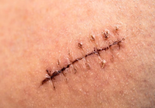 How Long Do Dissolvable Stitches Last? What You Need to Know for the Best Care