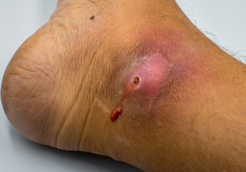 The Best and Worst Ways to Treat Open Wounds