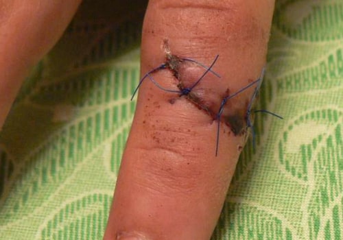 Navigating What Do Dissolvable Stitches Healing Stages Look Like During Emergency Wound Care