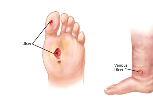 How to Distinguish Venous Ulcer Vs Arterial Ulcer Vs Diabetic Ulcer During Emergency Wound Care